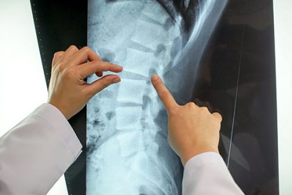 Osteogenesis Imperfecta Home Care Assistance Osteogenesis Imperfecta Home Care Assistance