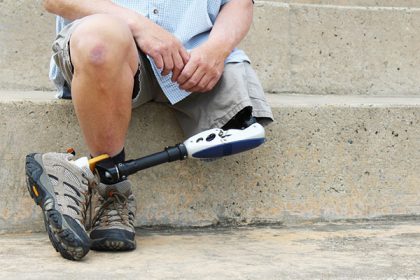What Amputation Home Care Assistance Do You Need What Amputation Home Care Assistance Do You Need